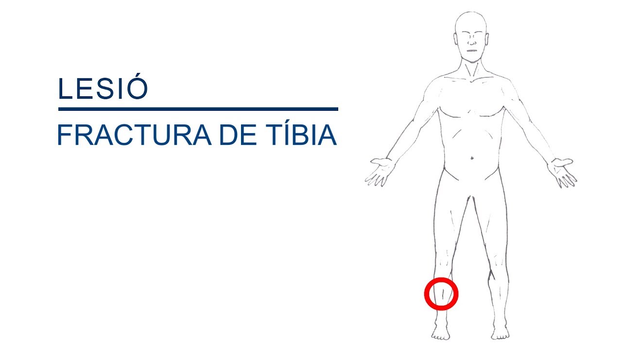Fractura de Tibia