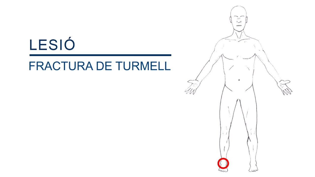 Fractura de tobillo