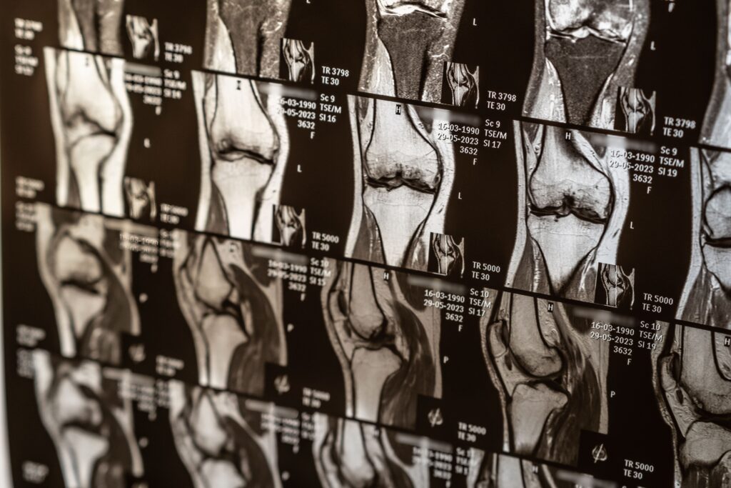 cartílago de la rodilla desgastado